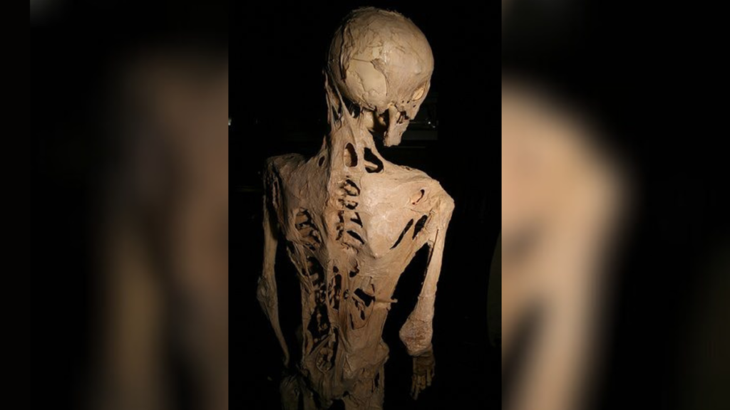 'Stone man disease': A rare condition that causes a person to grow a second skeleton